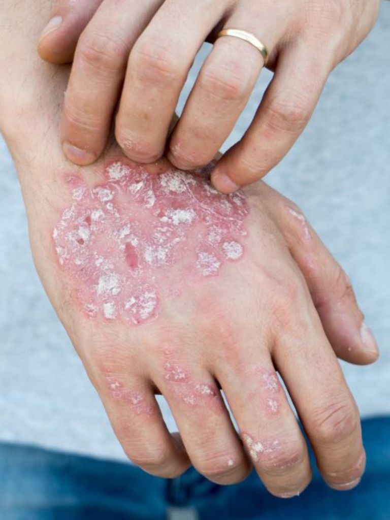 close up of man itching back of one of his hands covered in severe psoriasis dry red skin